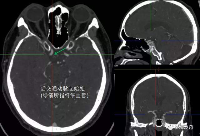 超实用的颈内动脉CTA分段