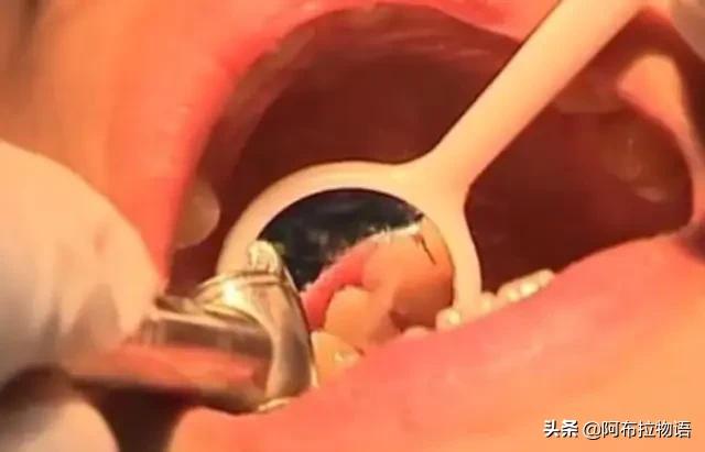 「超级宝妈」父母别扔掉孩子的乳牙，关键时刻能救孩子一命，是真的吗？