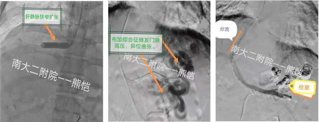 南昌大学第二附属医院消化内科2020年TIPS首破百例再创新高