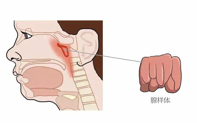 腺样体肥大和扁桃体肥大的区别