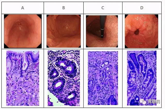 胃黏膜肠化，不要太担心；异型增生要小心