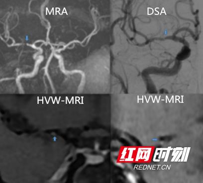 血管|高分辨血管壁MR成像，脑血管病患者的福音