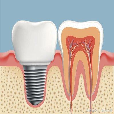 到底什么是种植牙，手术的过程是什么样的？真的值得做吗？
