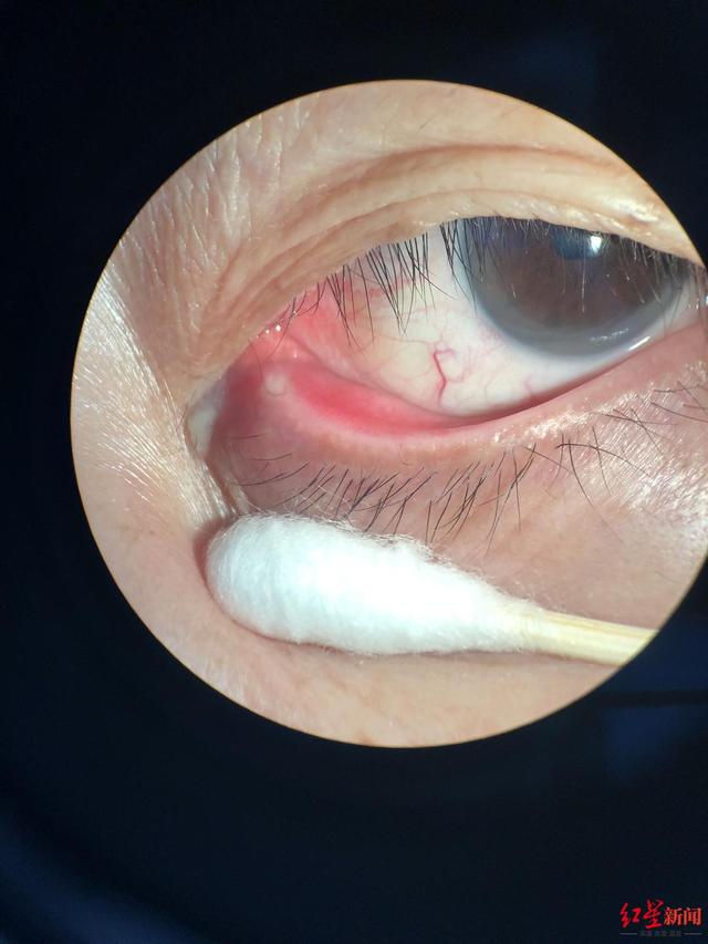 眼睛|60岁婆婆眼角总是有眼屎 一查竟是眼睛长了结石