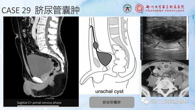 儿童腹部囊性病变诊断思路分析