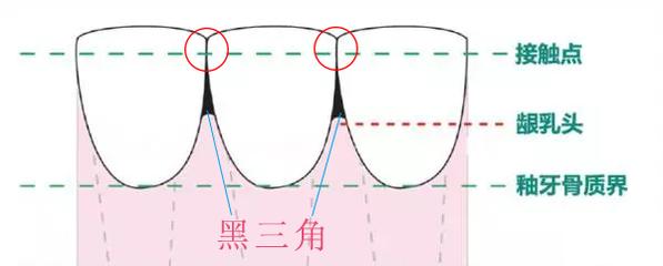 牙齿出现黑三角怎么办？真的是不可逆的吗？听听看牙医怎么说