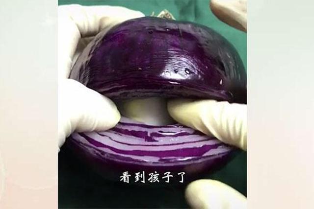 「画说育儿」网友给“洋葱”做剖宫产手术，过来人：又疼了一次！