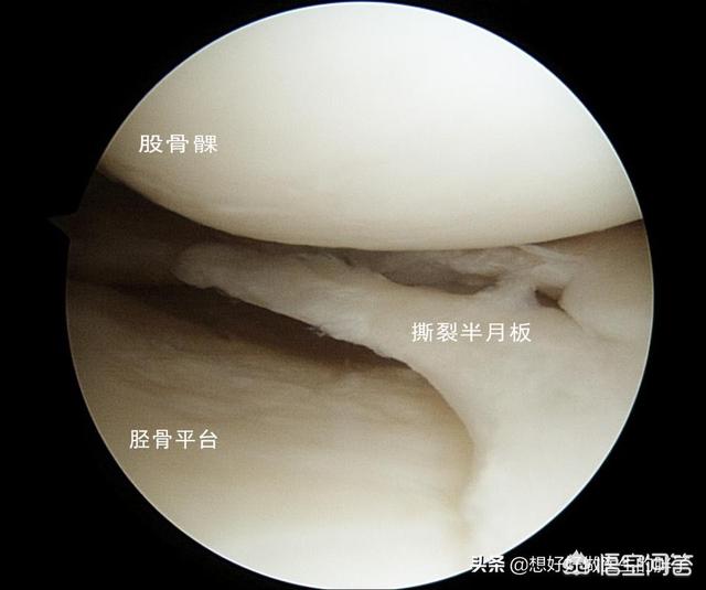 内侧半月板|为什么走平路膝关节不疼，但是打弯、下楼梯、蹲起时膝关节疼痛呢