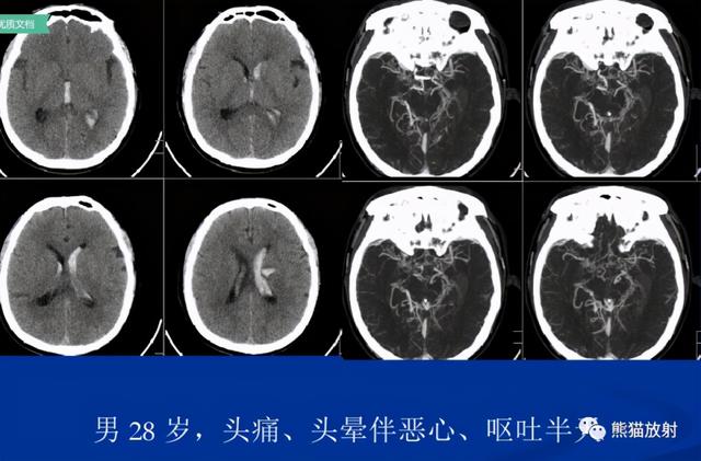 烟雾病的CT及MRI诊断