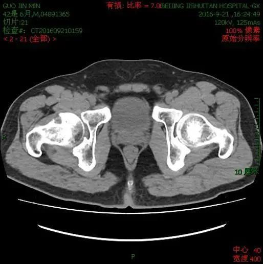 拍X光片能确诊股骨头坏死病情吗？