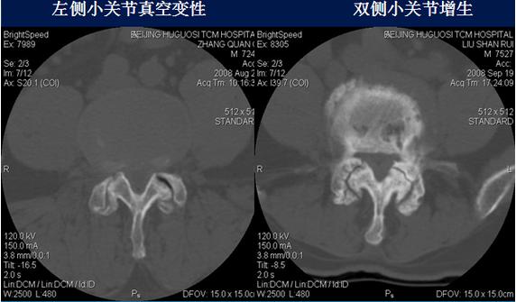 腰椎间盘CT诊断：椎间盘膨出、突出、椎管狭窄及退行性病变