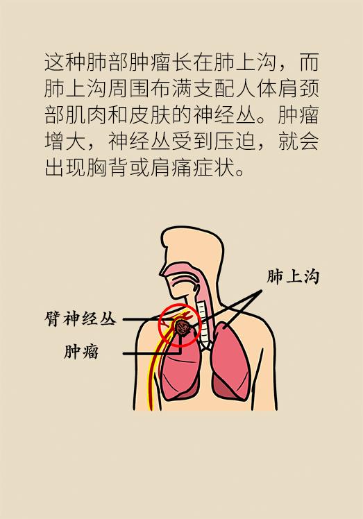 肩背痛竟然是肺癌？小心这些被忽视的?肿瘤信号?