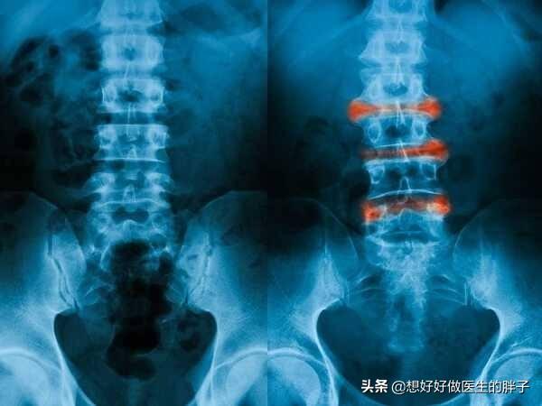 年轻男性、下背部疼痛，晨起加重活动缓解，要小心这个缠人的疾病