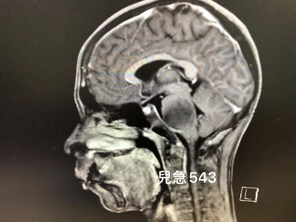 你的育儿经|小孩突脸歪、四肢无力！医揭1疾病家长恸