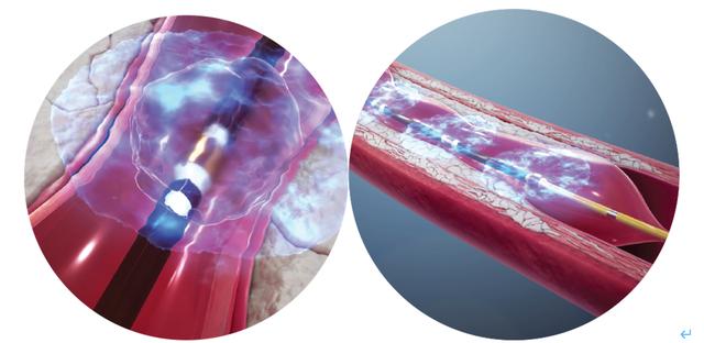 血管|心血管钙化患者福音：国内首次引进全球顶尖的“血管内冲击波”技术