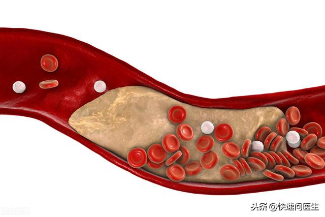 高脂血症能彻底治好吗？怎样可以降血脂？听听医生的建议