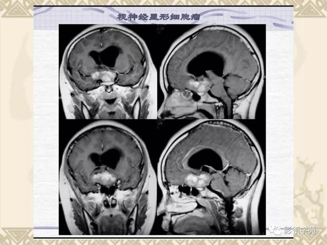 垂体病变的MRI诊断