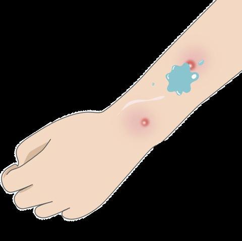 伤口|医生敲警钟！这里“小伤”莫大意，当心导致功能丧失