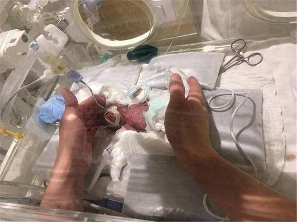 小树丫■世界上“最小的婴儿”，出生时1斤不到，现已长成挺拔少年