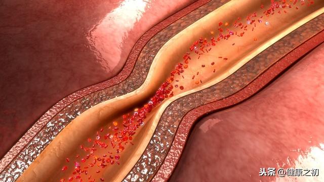 31年高血脂，从无并发症，只是做了这3点，医生：完全正确