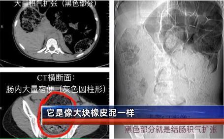 结肠|高二女生腹痛难忍寻医，一次排出8斤……马桶都堵了