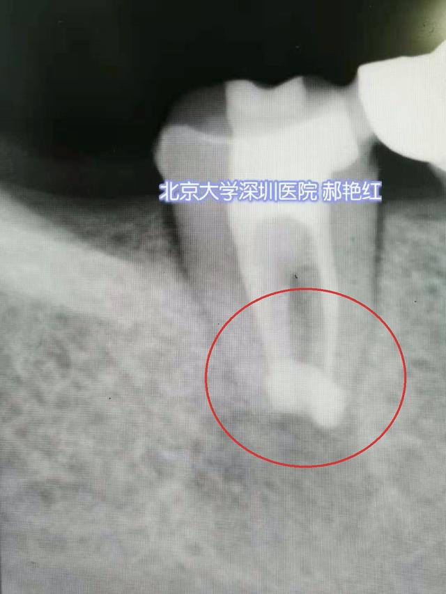 医生|拔下来的坏牙再种回去“活了”！北大深圳医院医生巧手留住天然牙