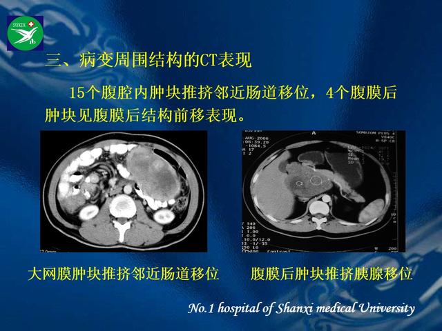 李健丁教授：胃肠道外间质瘤的CT表现和临床病理分析
