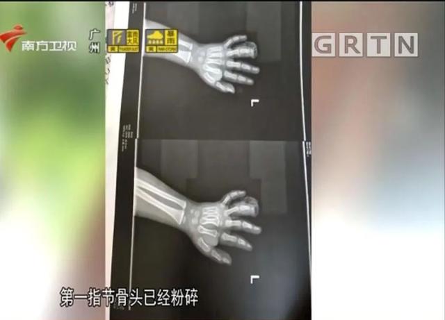 『广州日报』4岁男童手指被这种健身器械所伤,导致截肢!很多小区都有
