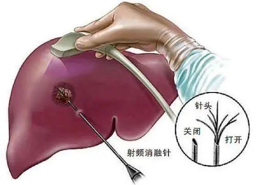 化疗|不用“开大刀”，烫死、饿死、毒死癌细胞，还可以这样做……