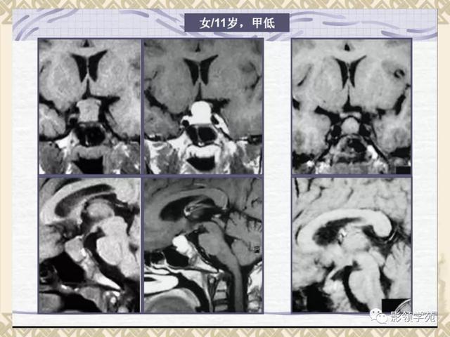 垂体病变的MRI诊断