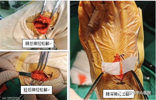 糖尿病周围神经病变外科治疗新方式