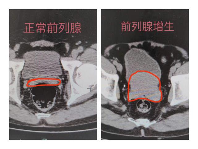 大伯|“一滴都尿不出来！”做了这件事后，六旬