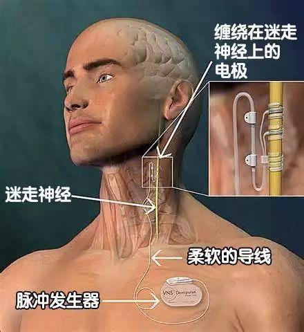 一男子被癫痫折磨十余年 医生用新技术“镇癫”获成功