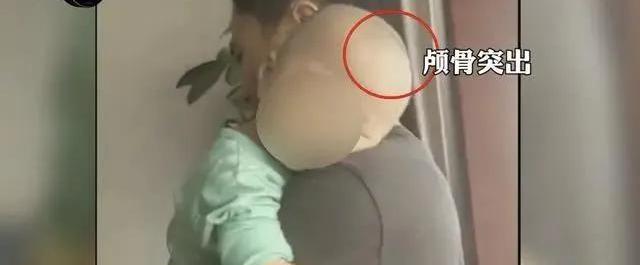 「超级宝妈」湿疹、酷似“大头娃娃”…多名幼儿食用同款“奶粉”后患同一种病