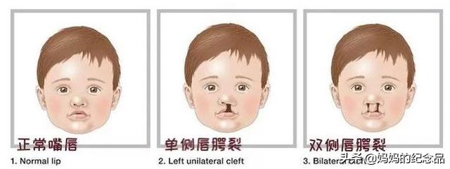 「你的育儿经」孕期小心翼翼，四维却查出“兔唇”，27岁孕妈勇敢做出抉择！
