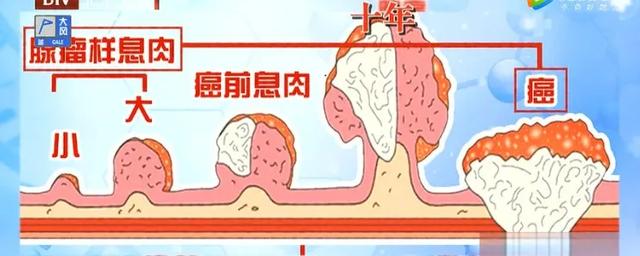 90岁名中医，每天午餐喝碗它，预防息肉、远离癌症，提高免疫力