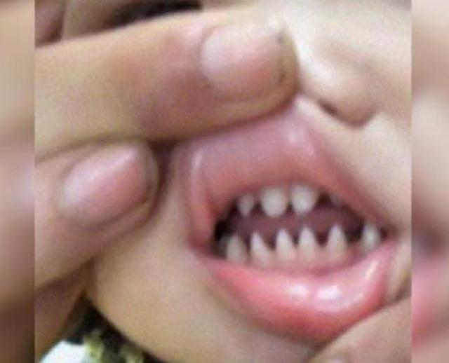 你的育儿经|宝宝长出“鲨鱼牙”，妈妈不敢喂他急忙送医，医生：太晚了