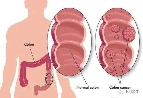 长了结肠息肉，你离肠癌还有多远？松江消化内科医师告诉你……