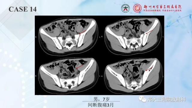 儿童腹部囊性病变诊断思路分析