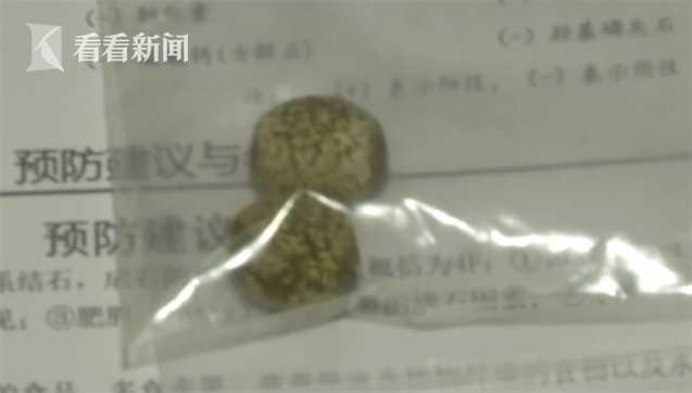 最爱油炸食物！“大胃王”妈妈生出“双胞胎”结石