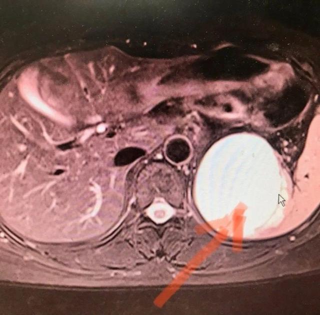 『你的育儿经』备孕期发现脾脏巨大肿瘤,微创手术顺利摘除,专家提醒:孕前,这些外科因素不可忽视