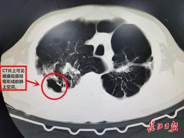 手术|肋骨痛了两年，原来是细菌抱团在肺上“安家”