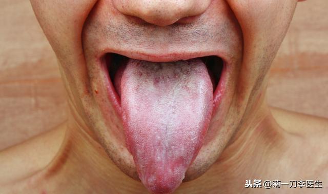 心脏病的舌头有何“玄机”？
