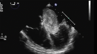 心电图|得了心脏病哪些检查最准确？这份“心脏检查指南”请收好！