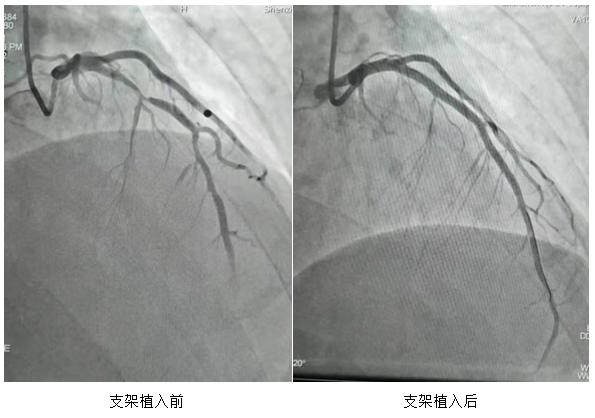 心脏支架降价后第一批受益者