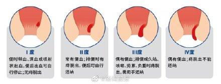 痔疮|蹲坑玩手机小心成有痔青年