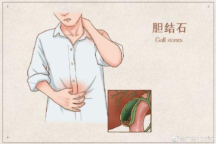 胆结石|胆结石疼起来真要命
