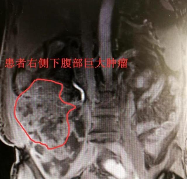 七旬老人反复腹泻，原是腹腔窝藏肿瘤