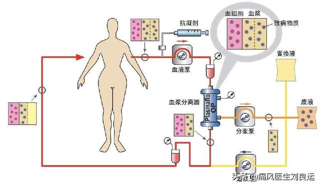 痛风发作后担心长痛风石？做好三件事预防尿酸盐结晶沉积在关节