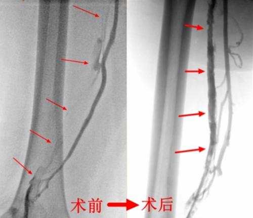 九江学院附属医院应用多项介入技术治愈一位高龄患者